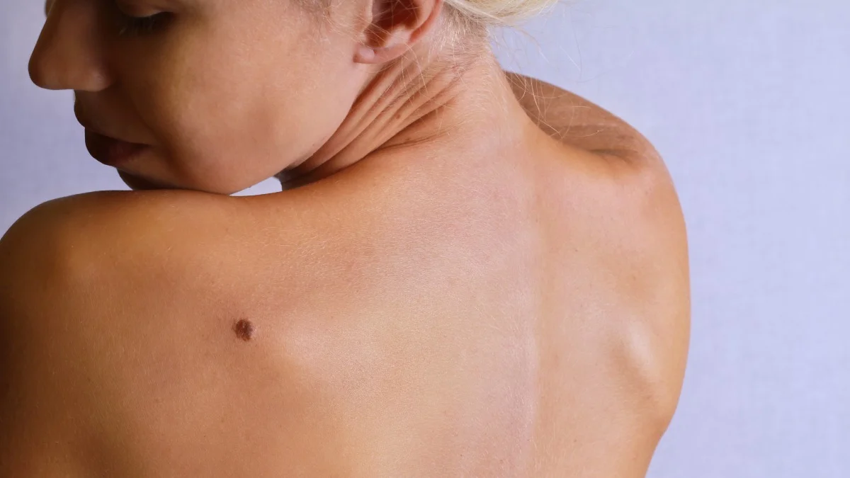 Melanoma: el enemigo silencioso que puedes detectar a tiempo